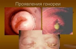 Ранние признаки гонореи у мужчин и женщин. Что делать в первую очередь