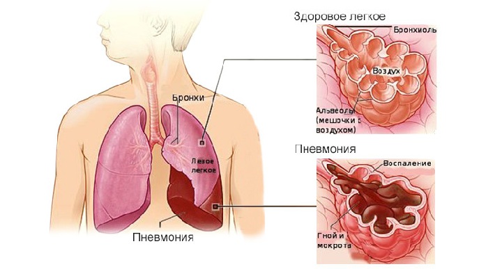 Воспаление легких