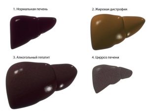 Что такое алкогольный гепатит и как его лечить