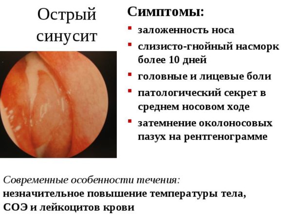 Причины возникновения и способы быстрого лечения ринита и синусита
