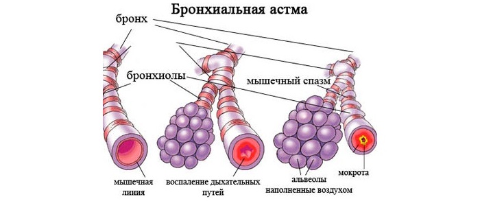 Астма и мокрота