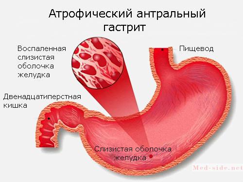 Все о причинах появления гастрита антрального отдела желудка: диагностика и правильное лечение