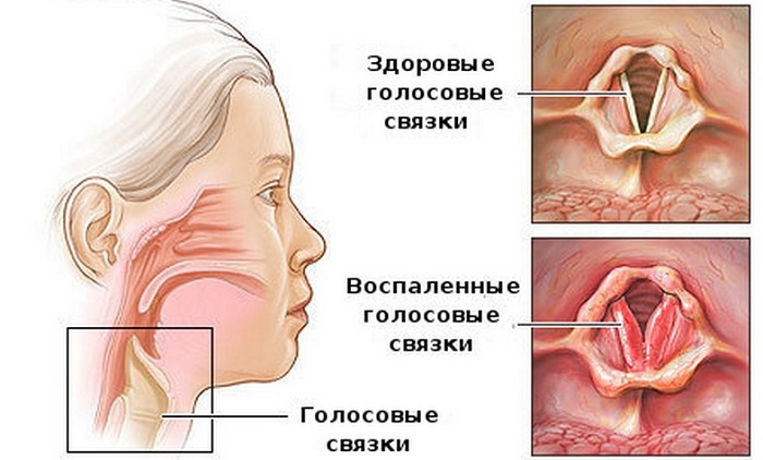 Ларингит