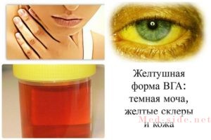 Краткий чек-лист по симптомам при болезни Боткина (гепатита А) у детей и подростков