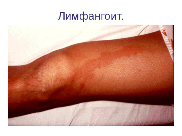 Развитие лимфангита