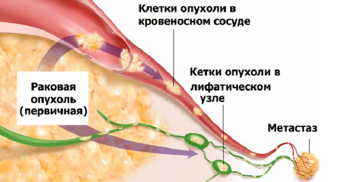 Метастазы