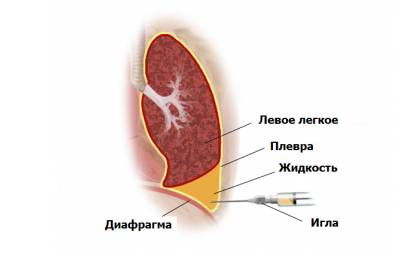 Плевроцентез