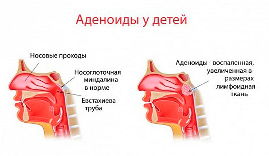 Аденоидит
