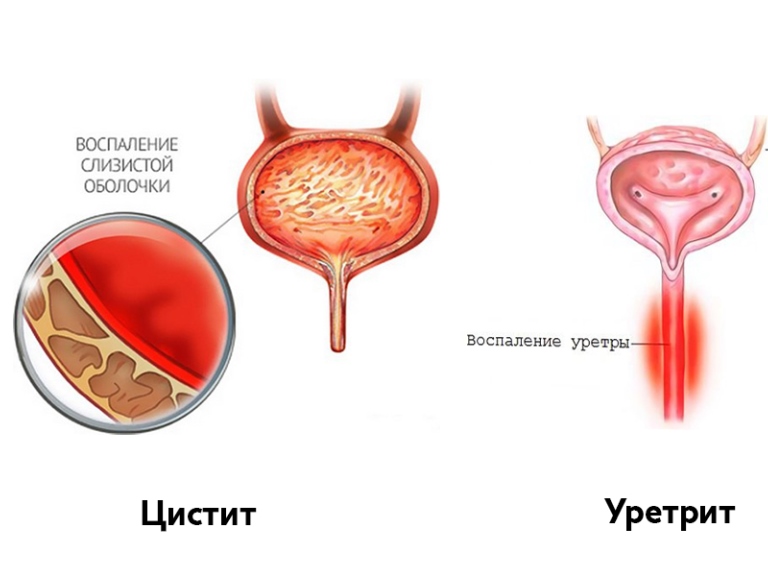 Отличие цистита и уретрита