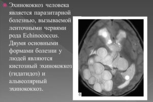 Эхинококкоз