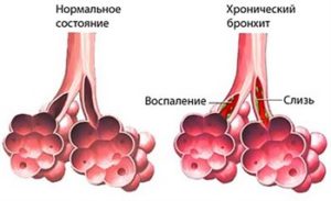 Опасен ли бронхит у детей. Избавление от воспаления бронхов и кашля у ребёнка