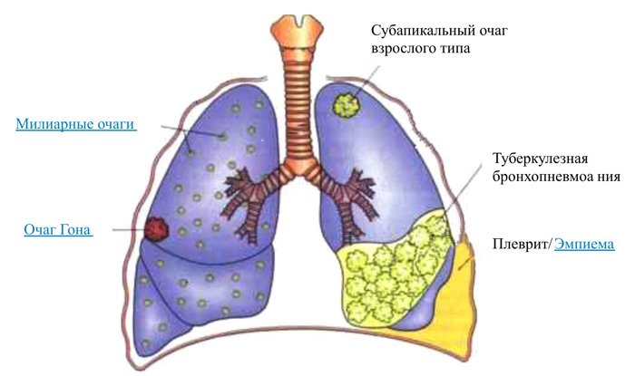 Виды очагов