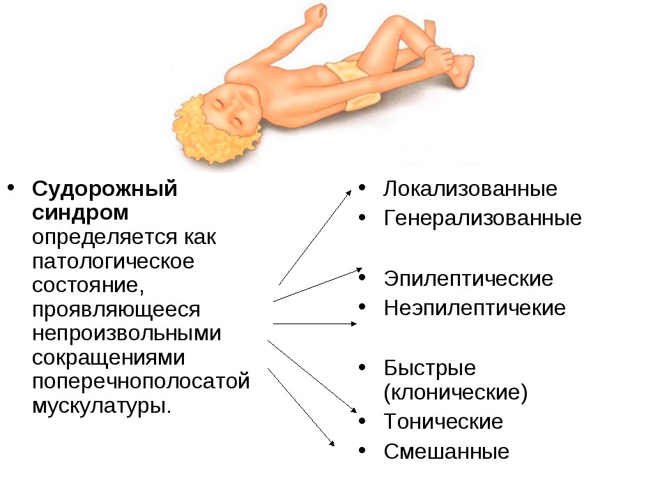 Судорожный синдром