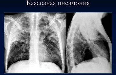 Снимок легких