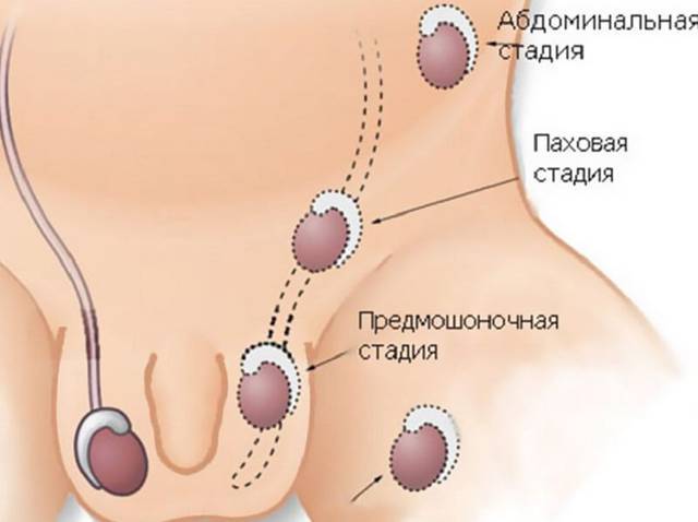 Крипторхизм у мальчиков