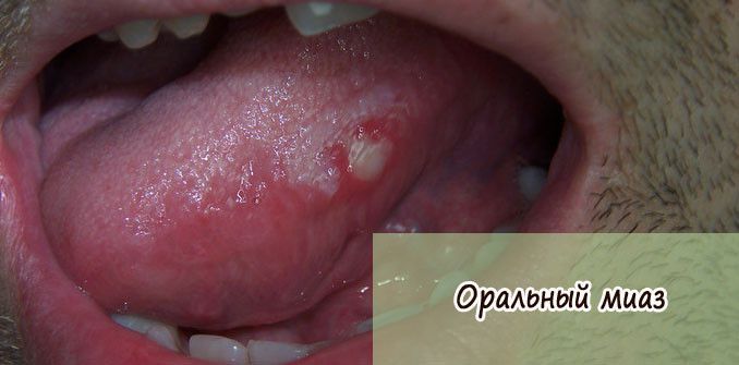 Оральный миаз