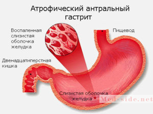 Недельный рацион для лечения антрального гастрита. Детальный разбор меню на 5 приёмов пищи