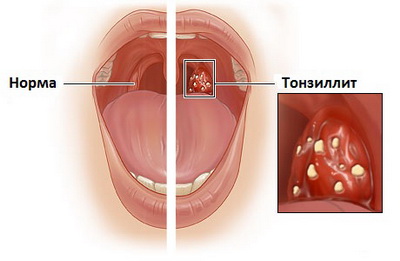 Тонзиллит