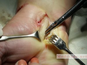 Туннельный синдром: варианты быстрого и безболезненного лечения