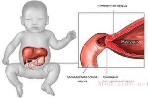 Что нужно знать маме, чтобы не пропустить пилоростеноз у ребёнка. Первые признаки, лечение и последствия стеноза вратаря