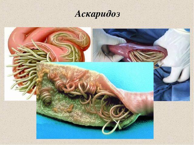 Аскаридоз