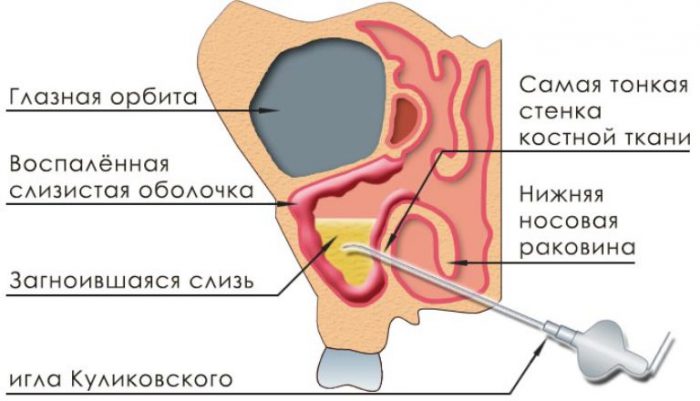 Пункция гайморовых пазух