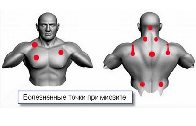Миозит
