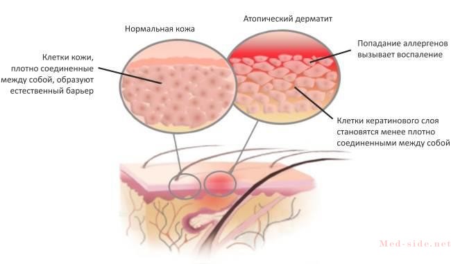 Ответ врача о причинах нейродермита. Описание самых эффективных способов лечения атопического дерматита у детей