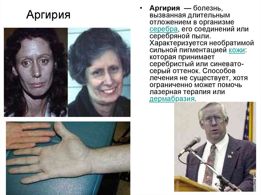 Аргирия