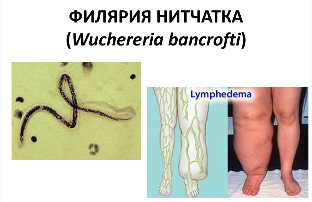 Филярия Банкрофта