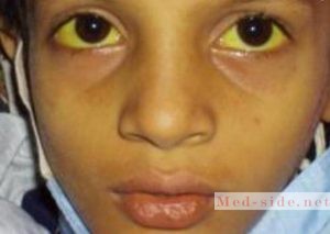 Краткий чек-лист по симптомам при болезни Боткина (гепатита А) у детей и подростков