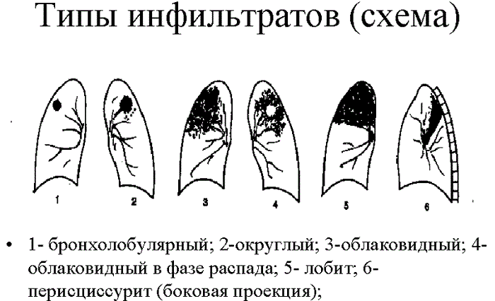 Инфильтрат