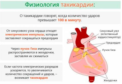 Тахикардия