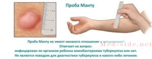 Поэтапное лечение туберкулеза для разных групп пациентов, терапия мультирезистентных форм