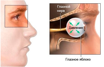 Повышение внутриглазного давления