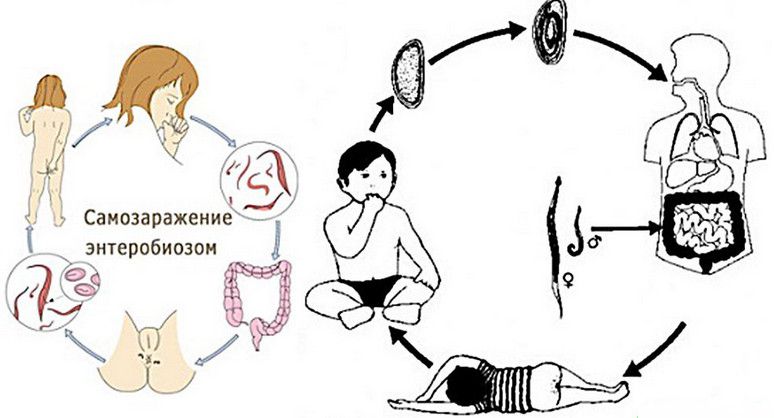 Энтеробиоз