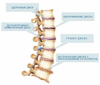 Степени грудного остеохондроза