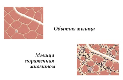 Миозит