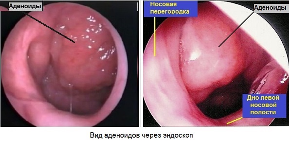 Аденоиды у детей