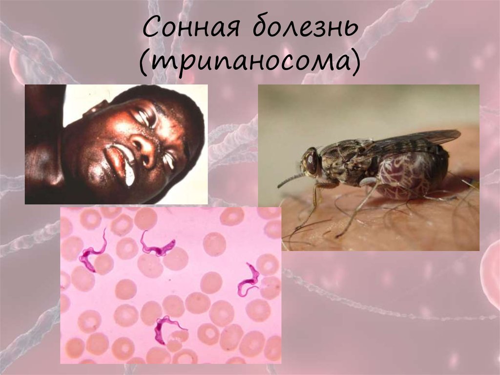 Сонная болезнь