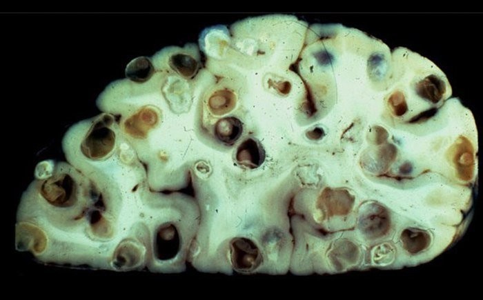 Неглерия Фоулера в тканях головного мозга