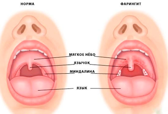 Фарингит
