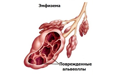 Больные легкие