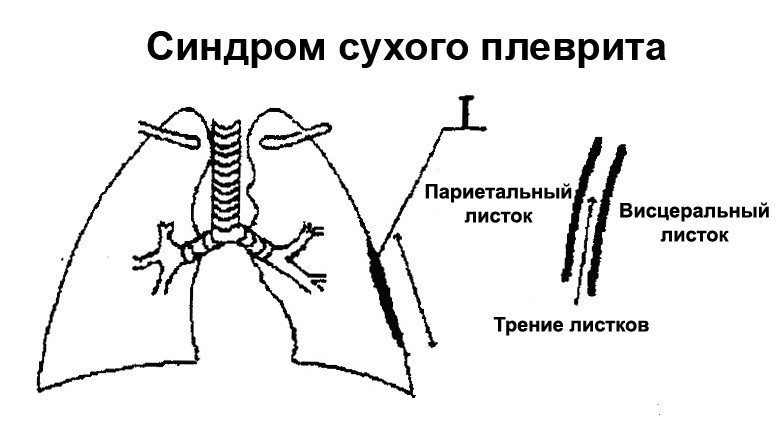 Синдром сухого плеврита