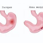 Как распознать признаки алкоголизма у мужчин, женщин и детей