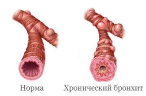 Опасен ли бронхит у детей. Избавление от воспаления бронхов и кашля у ребёнка