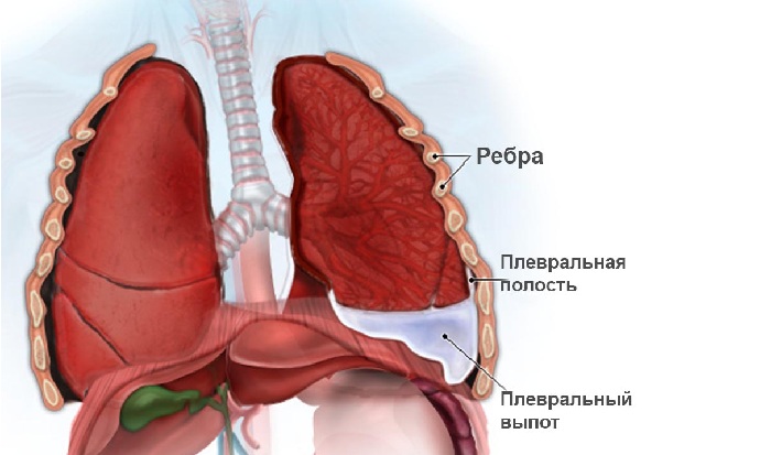 Плеврит