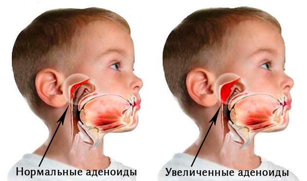 Аденоиды у детей