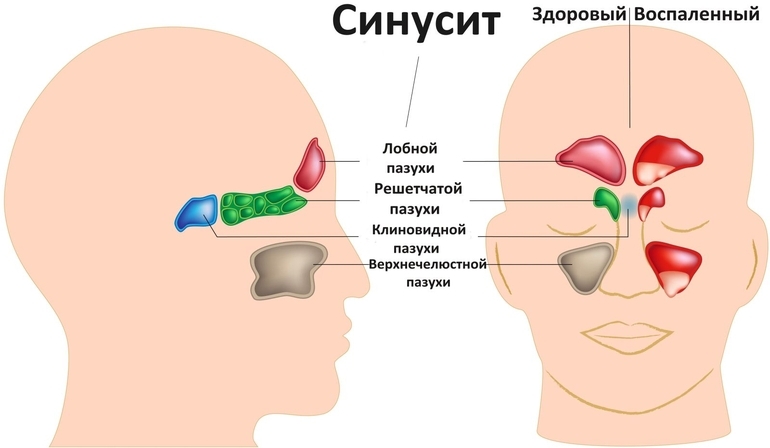 Симптомы и лечение синусита у детей