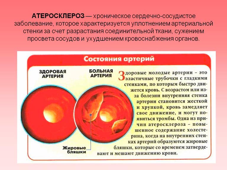 Атеросклероз